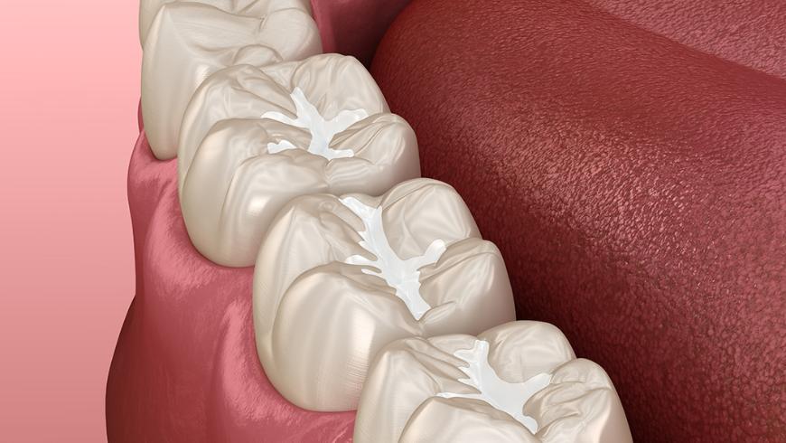 sigillature denti - dentista per bambini pescara